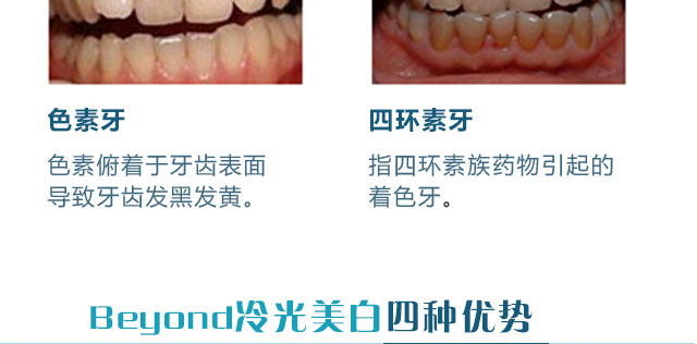 冷光美白