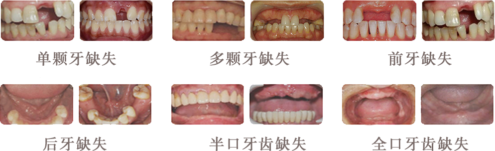 5D种植牙_秦皇岛口腔医院